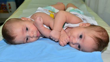 Iraqi Siamese twins Chris and Christian Ramson Corial lying on a hospital bed in Riyadh. (AFP)