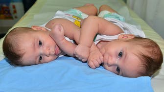 Saudi medical team separates conjoined twins