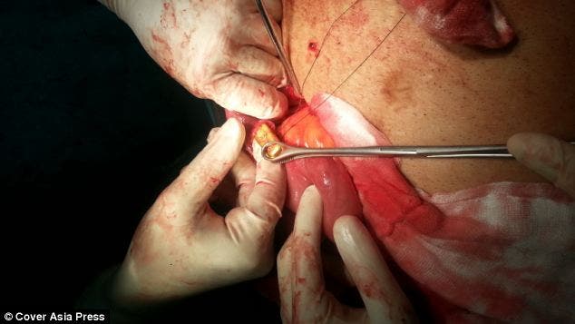 12 سبيكة ذهبية في معدة رجل اعمال هندي