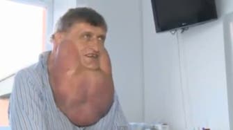 Video: doctors remove 6kg tumor from Slovakian man’s face