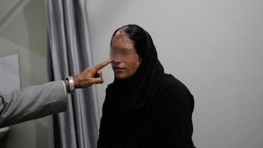 Tahira, 28, an acid attack survivor, is photographed during an appointment for reconstructive surgery at a hospital in Karachi December 14, 2011. (Reuters)