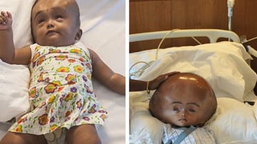 hydrocephalus before and after