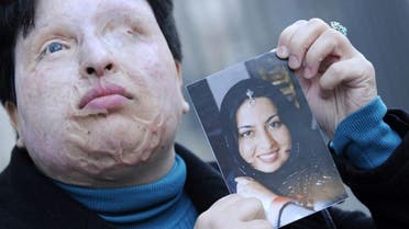 Victim Ameneh Bahrami before and after she was attacked with acid. (AFP)
