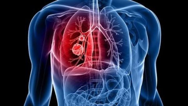 A “hidden killer” results in lung cancer for non-smokers, a study reveals