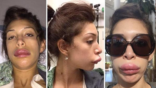 Teen Mom Star Farrah Abraham Reveals Botched Lip Job On Twitter Al