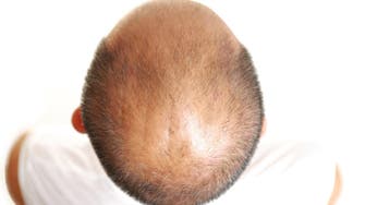 Scientists develop potential cure for baldness