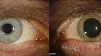 Shocking photo shows how Ebola lingers in eye of a survivor