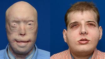 چہرے کی مکمل تبدیلی کی منفرد اور طویل ترین سرجری
