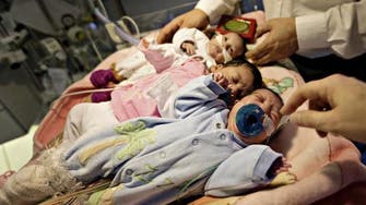 Youngest ever conjoined twins separated in Switzerland