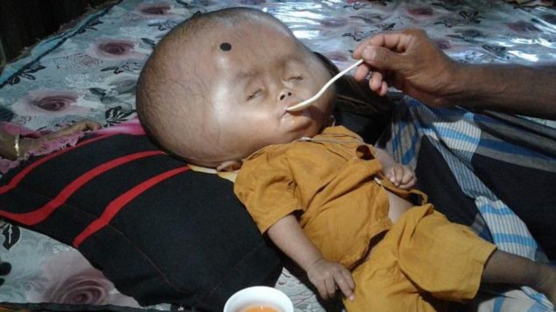 The boy with the 20lb head