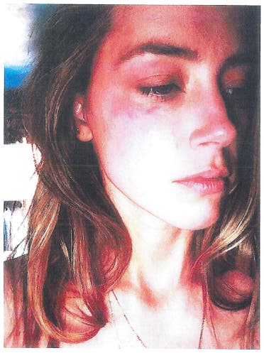 Actress Amber Heard is pictured in Los Angeles, California, U.S. with what appears to be bruising on her right cheek in an undated handout photograph included in a court filing for a restraining order against husband Johnny Depp. Superior Court of Los Angeles/Handout via Reuters