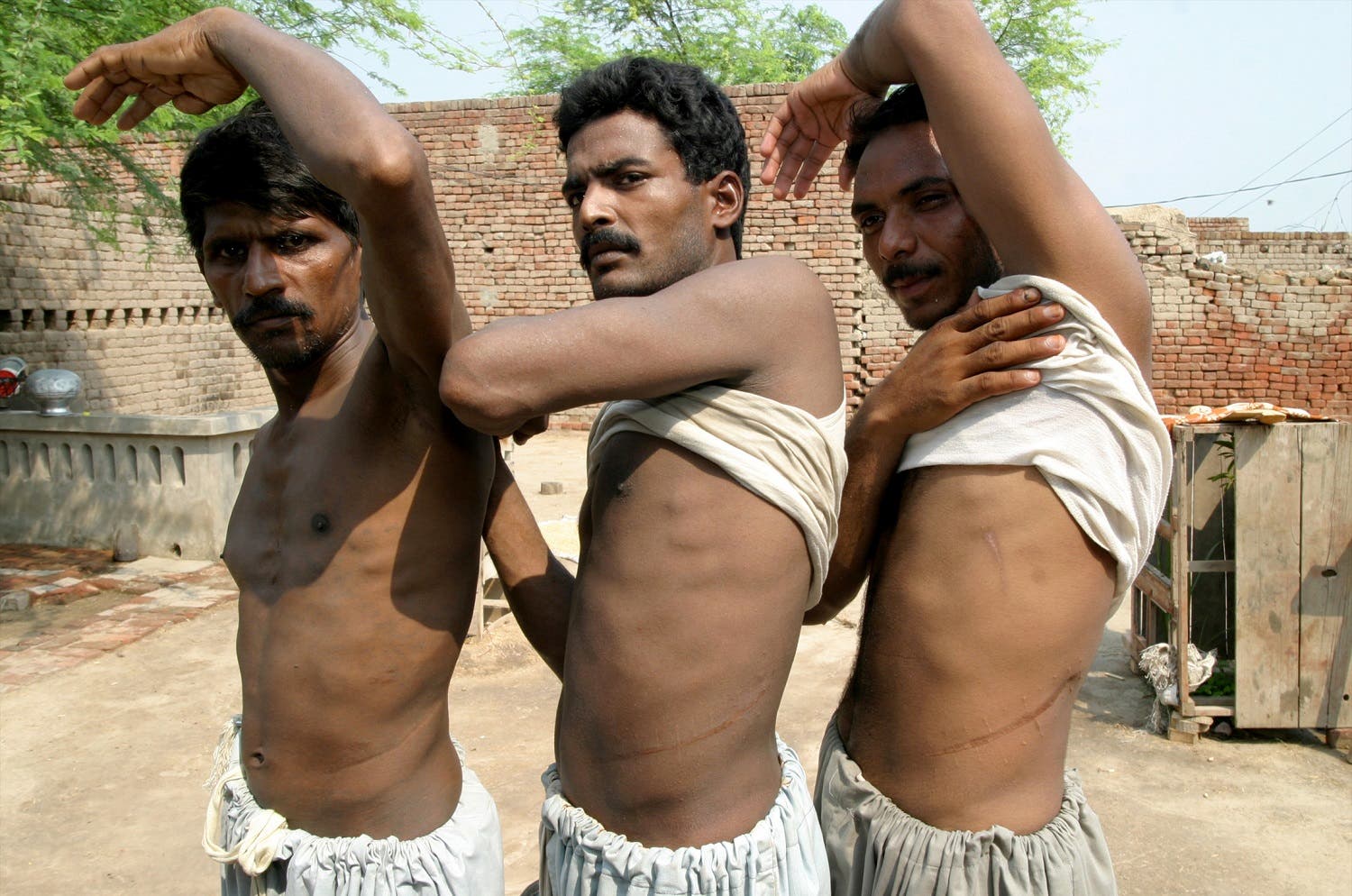 Mohammad Khalid (L), Mohammad Ijaz (C) and Liaqat show scars left on their bodies after they sold their kidneys in Bhalwal area of the Sargodha district July 10, 2006. (File photo: Reuters)