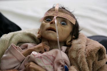 In this Tuesday, March 22, 2016 photo, infant Udai Faisal, who is suffering from acute malnutrition, is hospitalized at Al-Sabeen Hospital in Sanaa, Yemen. ap