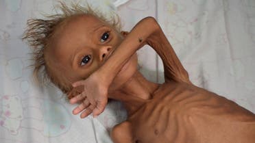 A malnourished boy lies on a bed at a hospital in the Red Sea port city of Houdieda, Yemen September 9, 2016. (reuters)