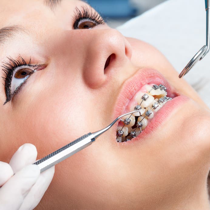 Шүдний ортодонтийн эмчилгээ