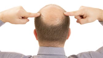 Has a cure for baldness finally been found?