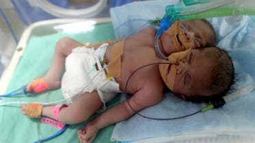 Palestinian conjoined twins lie in an incubator a day after they were born at Shifa hospital in Gaza City November 23, 2016. REUTERS