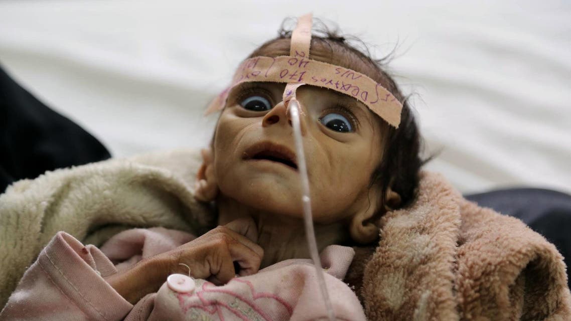 2016 AP YEAR END PHOTOS - Udai Faisal, an infant who is suffering from acute malnutrition, is hospitalized at Al-Sabeen Hospital in Sanaa, Yemen, on March 22, 2016. Udai died on March 24. Hunger has been the most horrific consequence of Yemen's conflict and has spiraled since Saudi Arabia and its allies, backed by the U.S., launched a campaign of airstrikes and a naval blockade a year ago. (AP Photo/Maad al-Zikry, File)