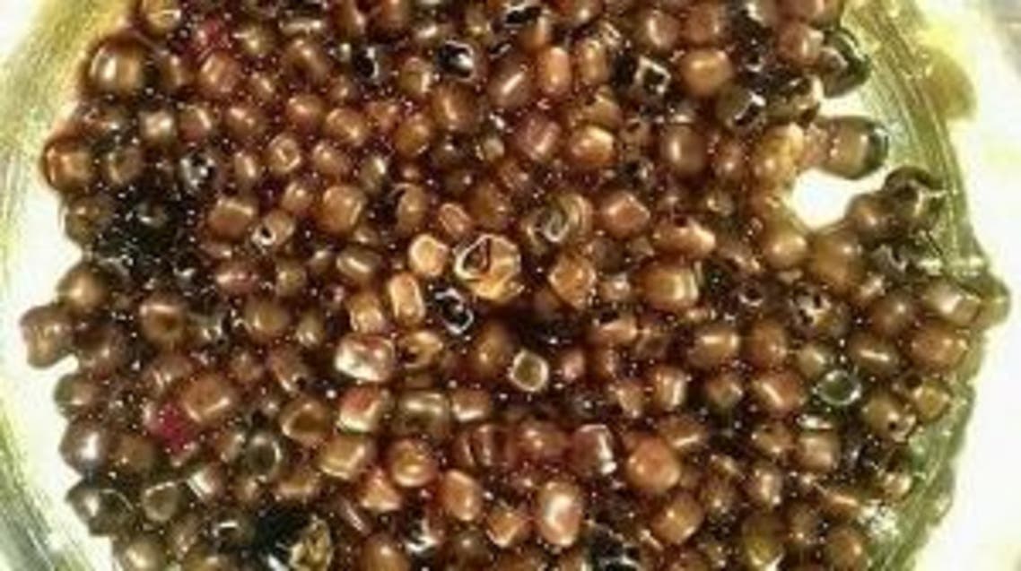 حصوات تم استخراجها من مرارة سيدة مصرية