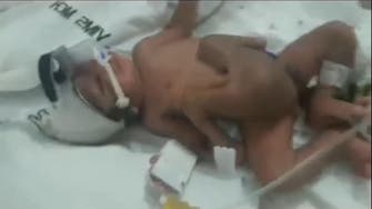 Baby born with four legs is ‘God’s gift’, say Indian parents