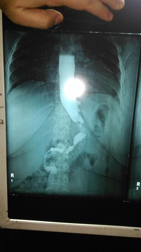 صورة اشعة لمريضة اجرت عملية تكميم معدة ويظهر فيها حجم المعدة بعد تصغيره
