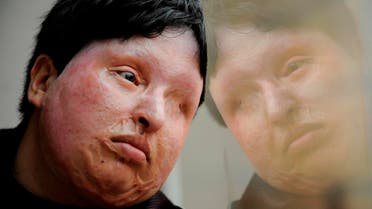 In this March 4, 2009 file photo, Ameneh Bahrami, who was blinded and disfigured by a man who poured acid on her face in 2004 for rejecting his marriage proposal, poses for a portrait at a hospital in Barcelona, Spain. (AP)