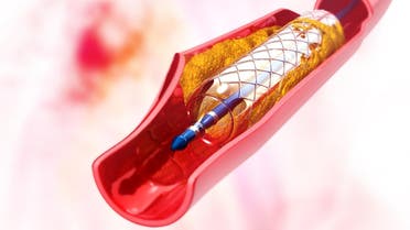stent image from shutterstock used for fake drugs in pakistan story