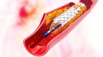 Stents no better than drugs for many heart patients: US study