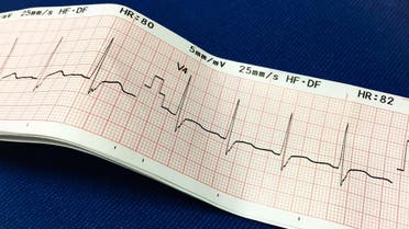 Electrocardiogram - (Shutterstock)