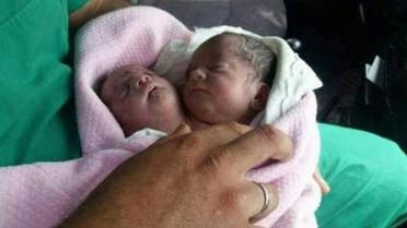 A child was born with one body and two heads in the Syrian city of Idlib. (Al Arabiya)