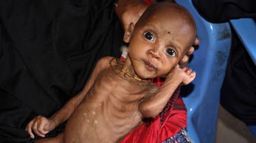 In this photo taken Saturday, Feb. 25, 2017, malnourished baby Ali Hassan, 9-months-old, is held by his mother Fadumo Abdi Ibrahim, who fled the drought in southern Somalia, at a feeding center in a camp in Mogadishu, Somalia. AP