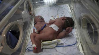 Doctor: Conjoined twins born in Gaza will need care abroad 