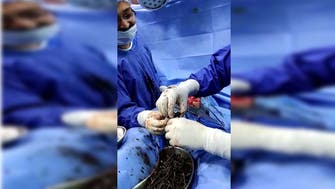 Cache of 639 nails recovered from schizophrenic’s belly in India 