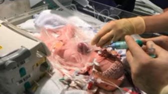 Baby's heart placed back inside her chest in rare surgeries