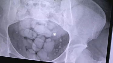 This December 29, 2017 photo shows the X-ray of the woman with small packages of cocaine in her stomach at Phuket International Airport. (AFP)