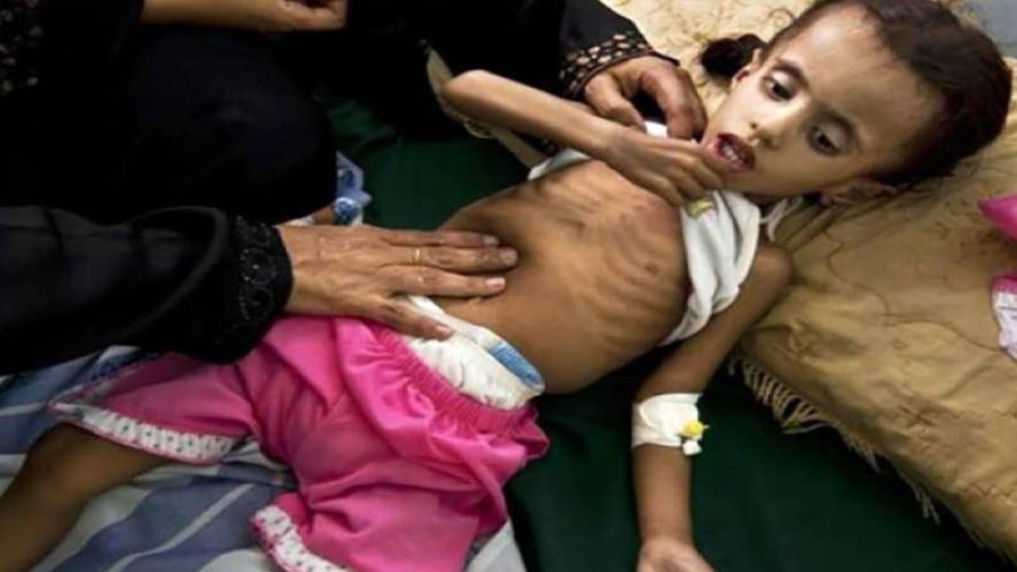 سوء التغذية بين الاطفال في المحويت