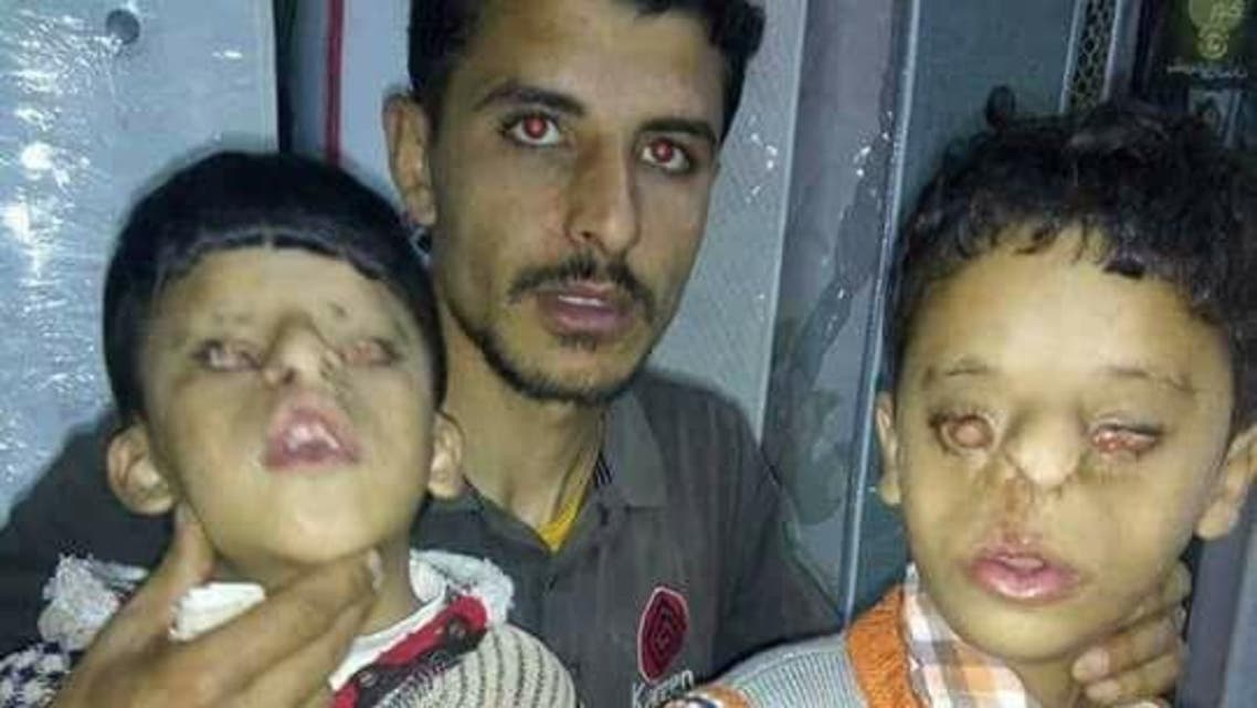 صور لمأساة طفلين مصريين ولدا بدون عينين