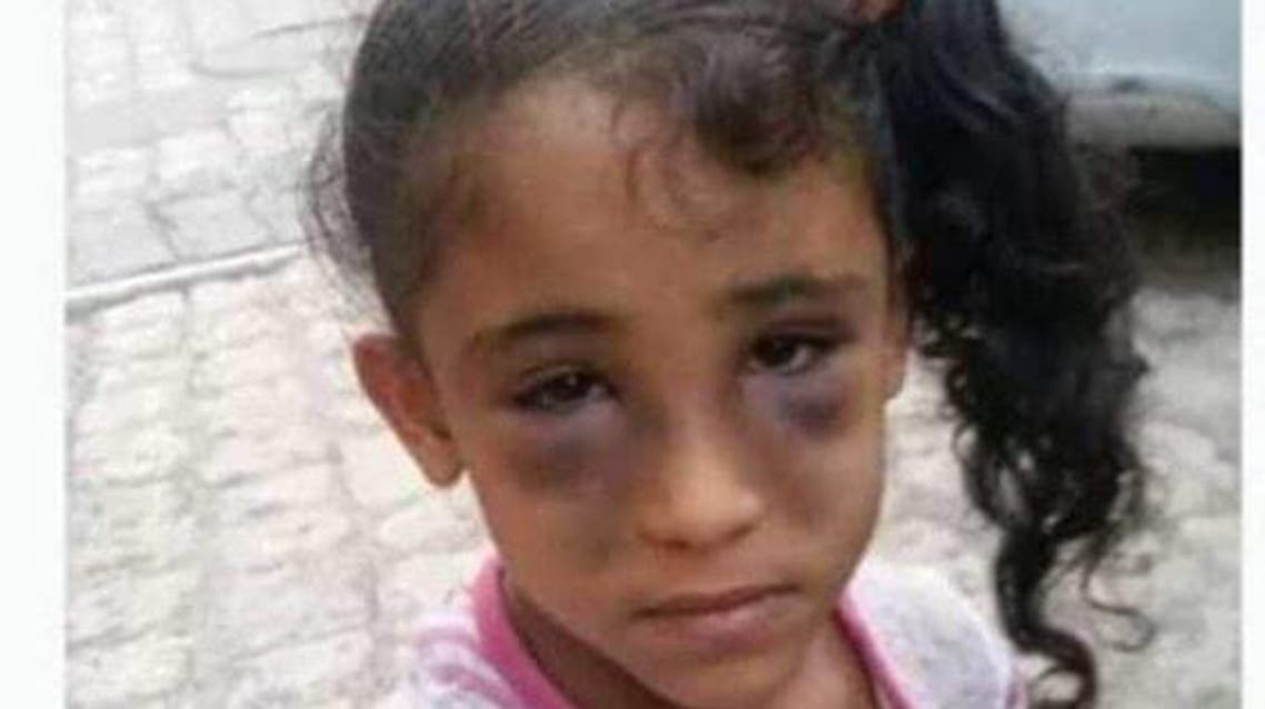 الطفلة شيماء واثار التعذيب الوحشي بادية على وجهها