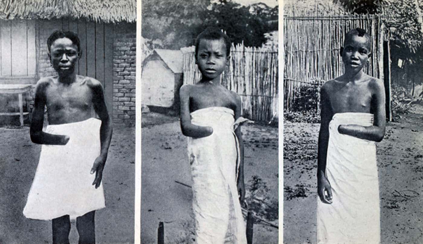 عدد من الكونغوليين الذين قطعت أيديهم من قبل المرتزقة البلجيكية