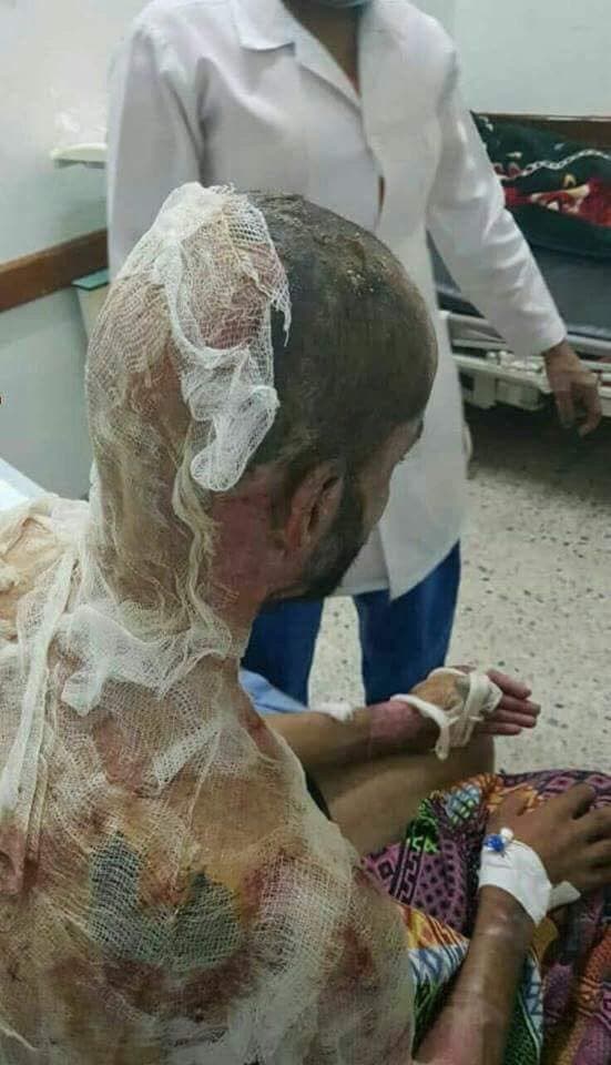 جروح وحروق