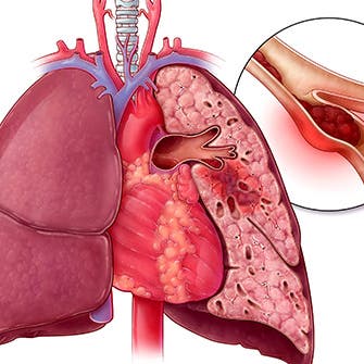 تلوث الهواء يسبب الانسداد الرئوي المزمن.. الصحة العالمية تحذر