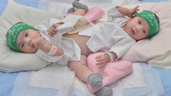 Surgery to separate Saudi conjoined twins postponed 