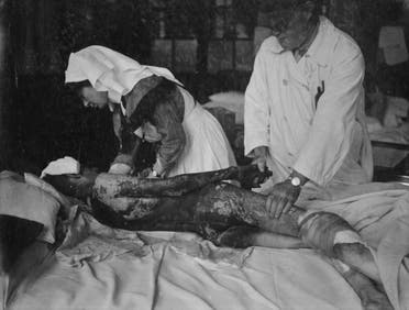 جندي بريطاني مصاب بحروق بليغة عقب اصابته بغاز الخردل سنة 1918
