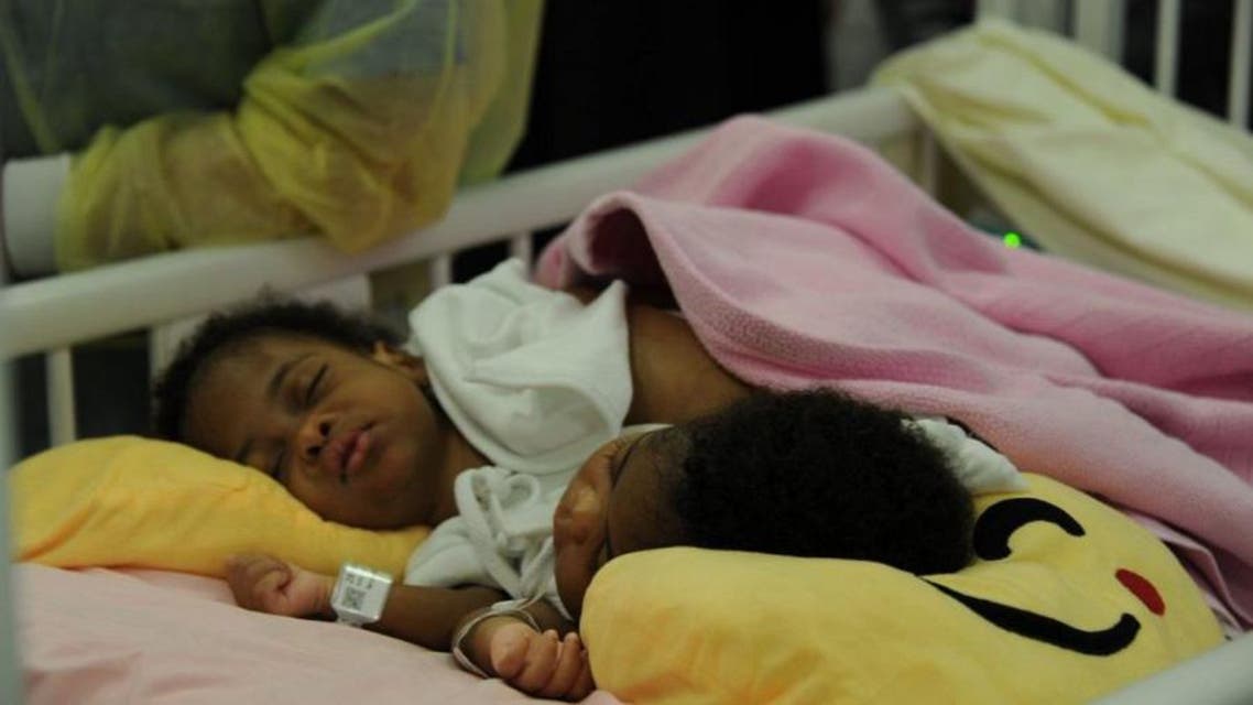 Siamese twins in Saudi. (SPA)