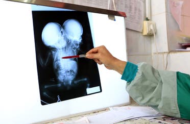 A doctor shows an x-ray image of conjoined twin boys who were born around 10 days ago, at a hospital near the Yemeni capital Sanaa on February 6, 2019. (AFP)