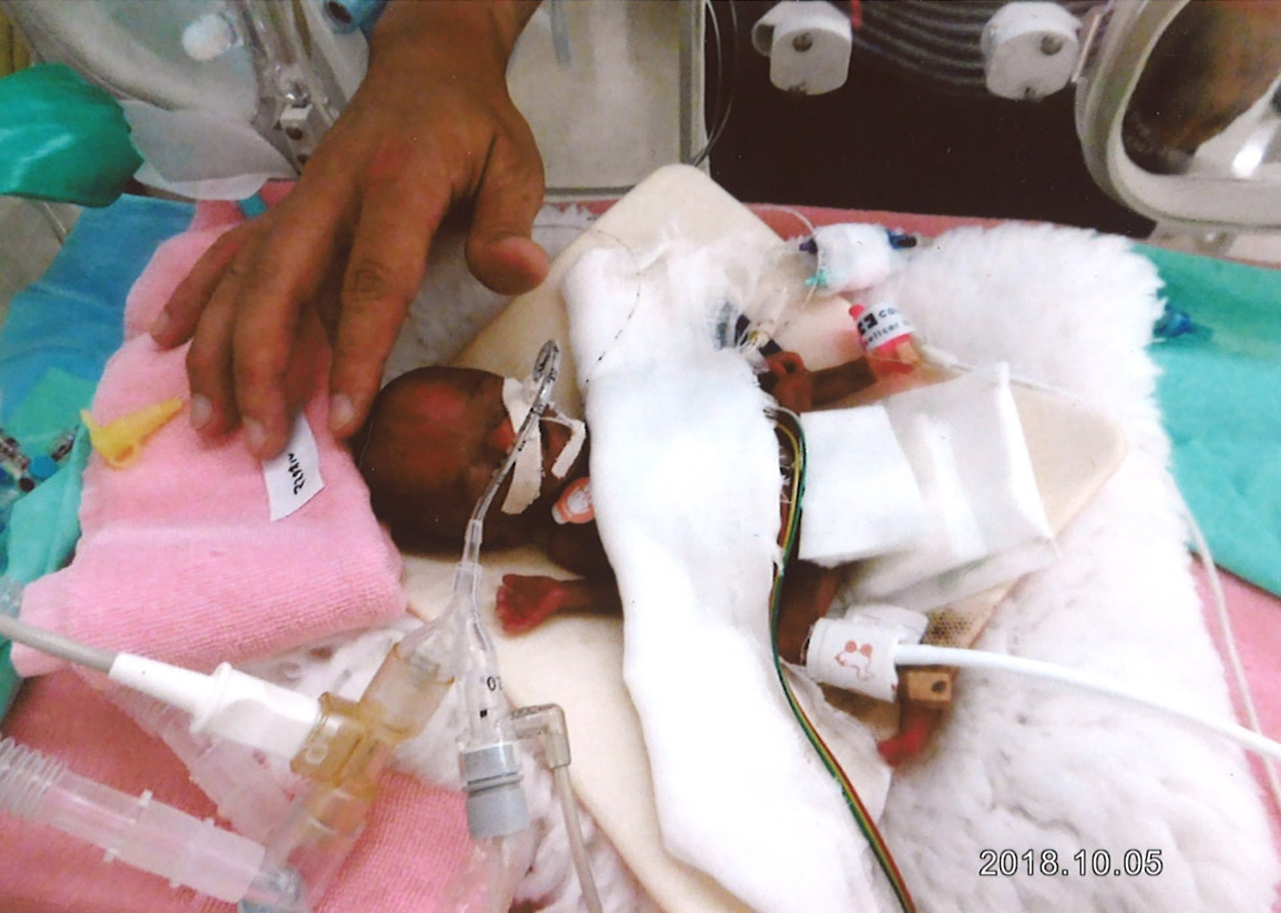 This handout picture taken on October 5, 2018 and released by Nagano Children's hospital on April 19, 2019 shows Ryusuke Sekiya being treated at Nagano Children's hospital in Azumino. (AFP)