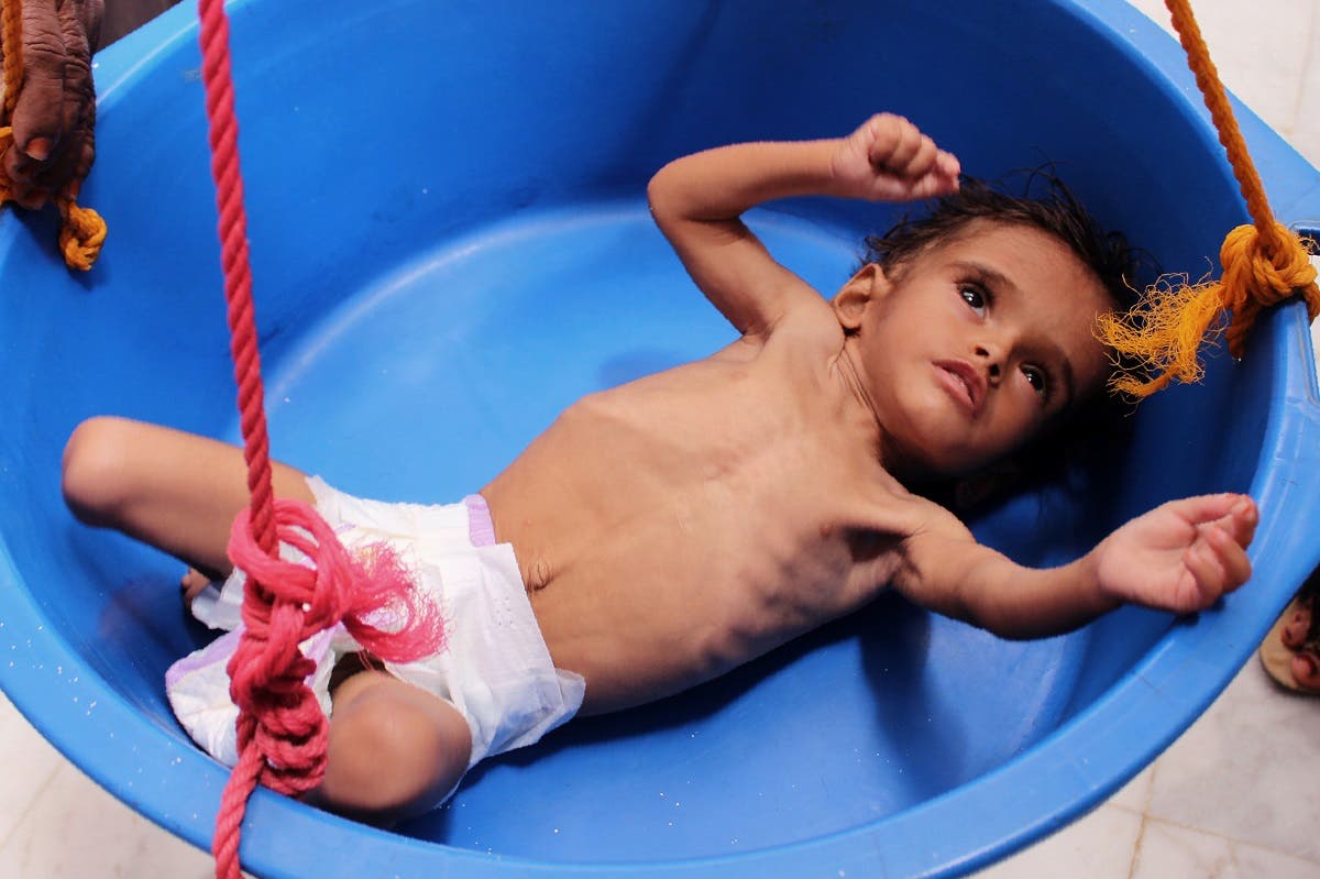 طفل يمني يعاني من سوء التغذية (أرشيفية)