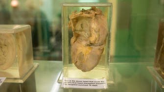 Czech teacher survives 34 years with heart transplant