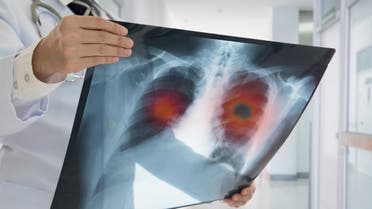 X-ray lung cancer - Stock image