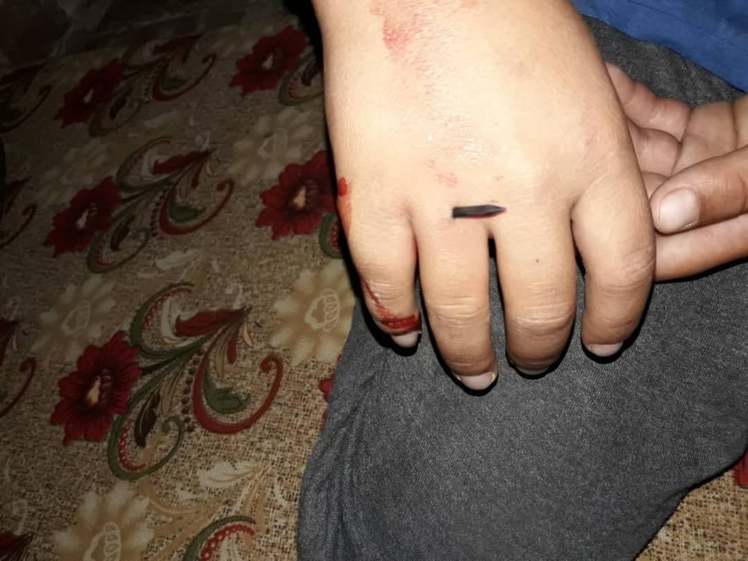 مسمار اخترق باطن يده وخرج من ظاهرها